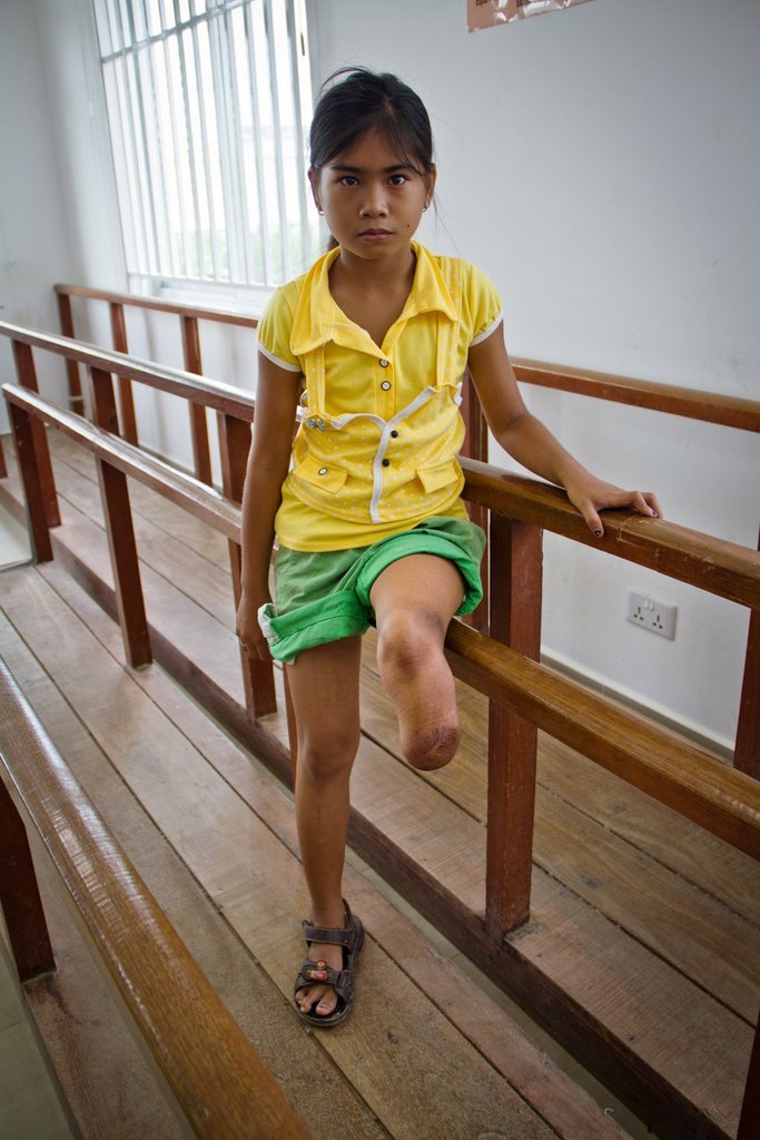 Give 40 Children in Asia the Ability to Walk!