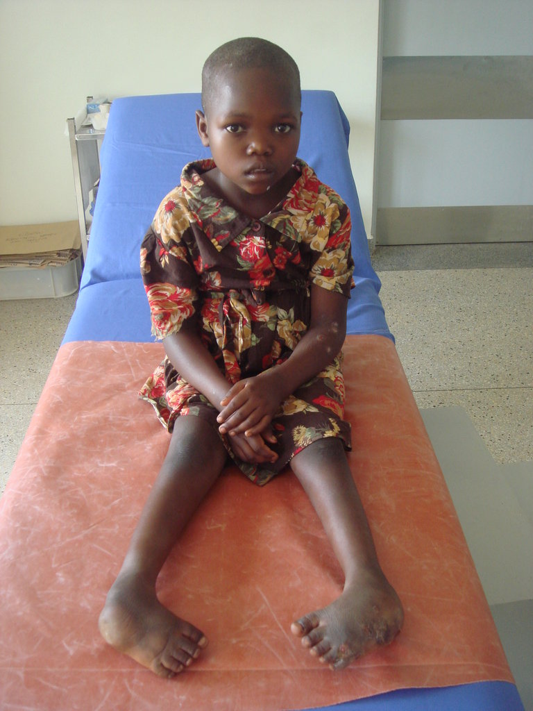 Give 40 Children in Asia the Ability to Walk!