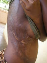 Girl pushed into fire with severe burns