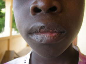 Boy with chronic mouth infection