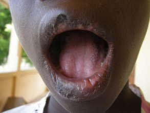 Boy showing chronic mouth infection