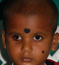 Nandini - Retinoblastoma Patient