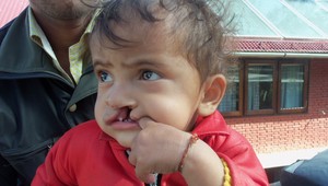 Pankaj with cleft lip and palate