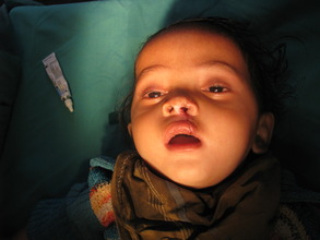 Pankaj after surgery at an Aarohi camp