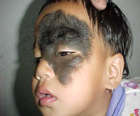 Large facial mole...