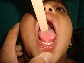 Tongue-Tie