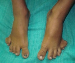 Polydactaly Bilat (excess toes) Pre-Op