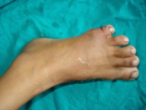 Post Op   Left Foot