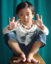Dipa 5yo girl with Syndactyly