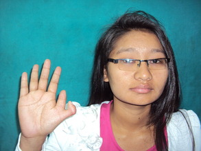 17 year old girl with polydactyly