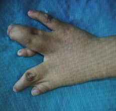 Left Hand    Before