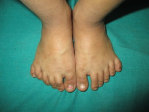 20 toes = 2 too many
