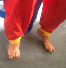 Post burn contractures of feet