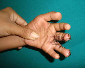 Ritima's hand after surgery