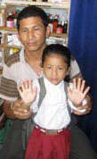 Shreya after corrective surgery