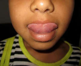 Tongue-Tie before corrective surgery