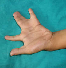 Syndactyly - Before