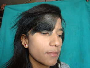Facial Hairy Mole - Before