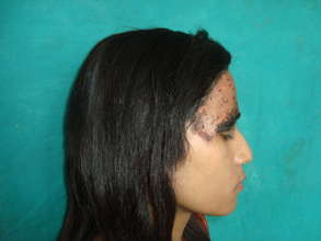 Facial Hairy Mole - After