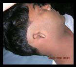 Example of microtia