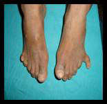 Example of polydactyly