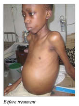 Before Treatment