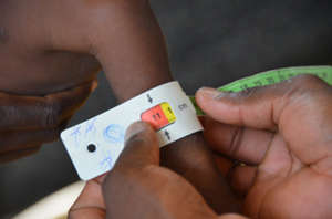 A child is measured for severe acute malnutrition