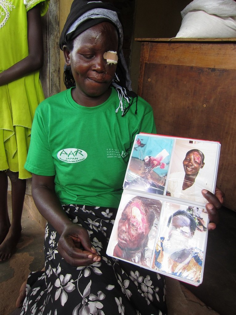 Supporting Landmine Victims in Uganda
