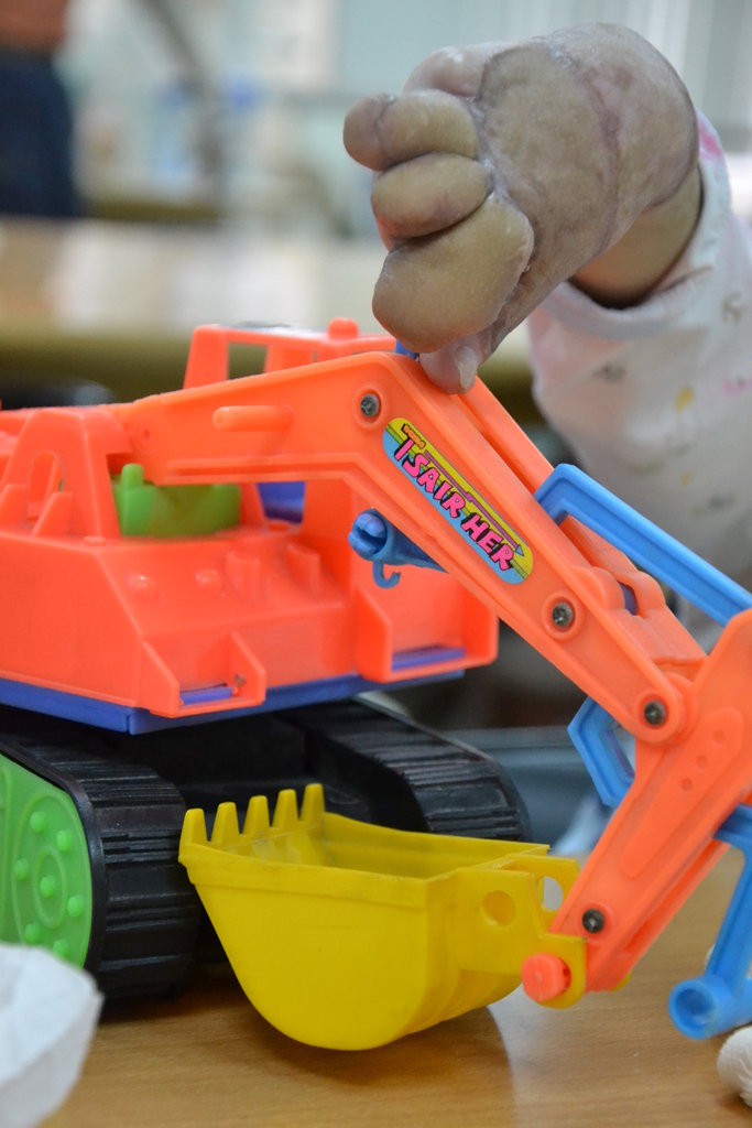 Rehabilitation for burn survivors in Taiwan