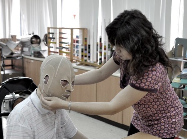 Rehabilitation for burn survivors in Taiwan