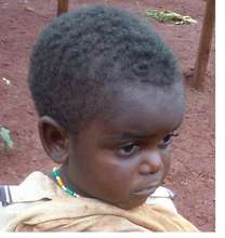 Surgery for Ruphat and 3 other boys in Cameroon