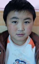 Ding De Peng before his surgery