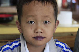 Xi Zin before his operation