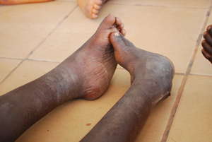 Untreated Clubfoot