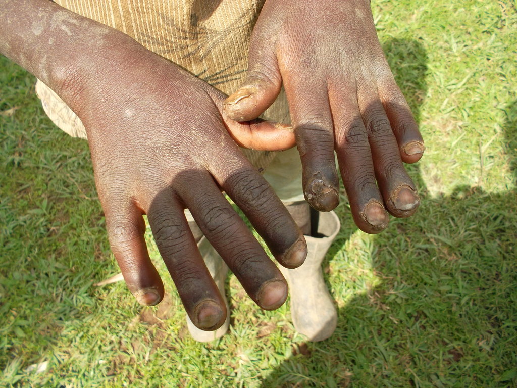 Jigger Skin Infection at Beatrice Theriault blog