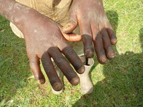 A child affected by jiggers on hands