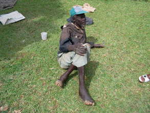 A man unable to walk due to jiggers on feet