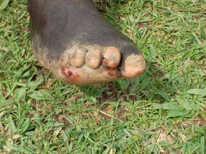 Infected foot of a man unable to walk