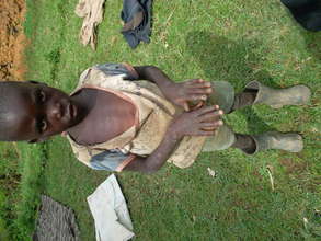 A child affected by jiggers on hands