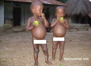 Malnourished Kids