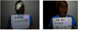 Before and After Cataract Surgery