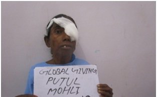 Putul after operation