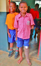 Amos just got a new prosthetic leg!