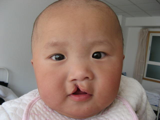 Free Cleft Surgery for 600 Poor Chinese Children