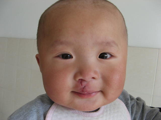 Free Cleft Surgery for 600 Poor Chinese Children