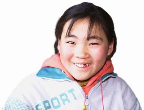 Free Cleft Surgery for 600 Poor Chinese Children