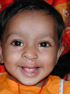 Anu, age 2, after