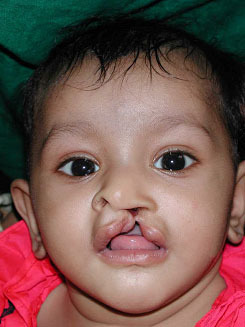 Anu, age 2, before