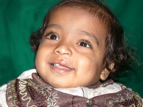 Free Cleft Surgery for 400 Poor Children in India