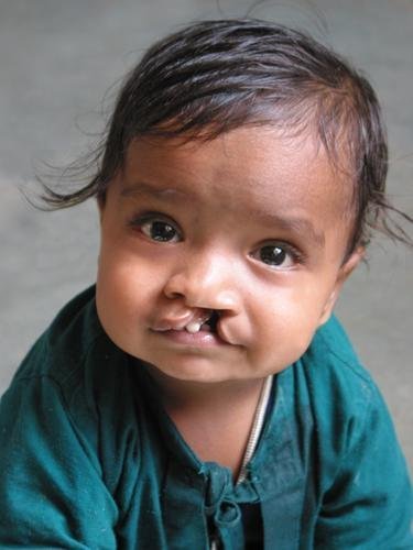 Free Cleft Surgery for 400 Poor Children in India